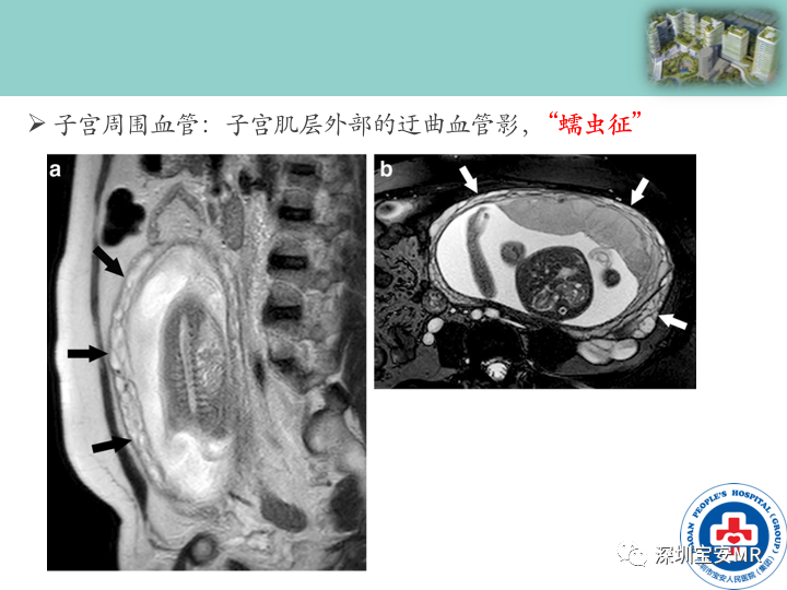 影像PPT - 【PPT】胎盘植入疾病MR评估-18