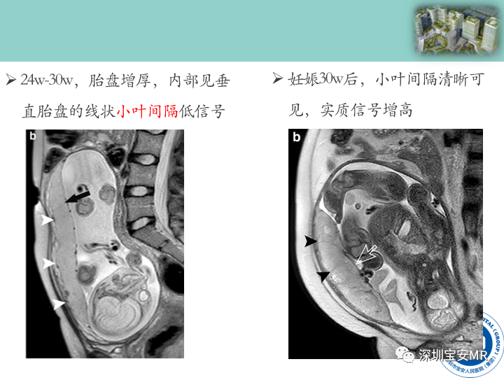 影像PPT - 【PPT】胎盘植入疾病MR评估-15