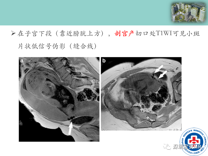 影像PPT - 【PPT】胎盘植入疾病MR评估-20