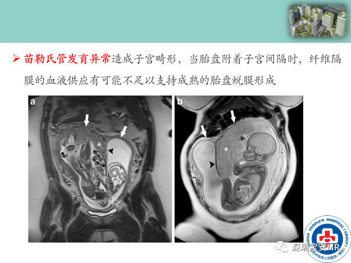 影像PPT - 【PPT】胎盘植入疾病MR评估-19