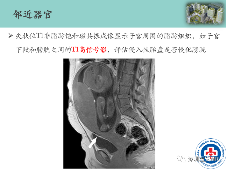 影像PPT - 【PPT】胎盘植入疾病MR评估-21