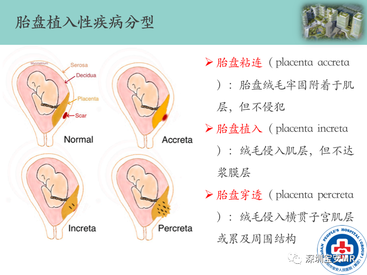 影像PPT - 【PPT】胎盘植入疾病MR评估-24
