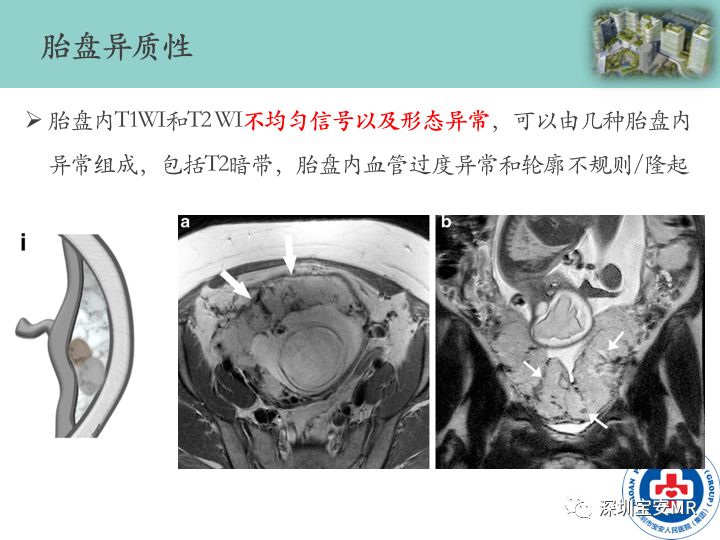 影像PPT - 【PPT】胎盘植入疾病MR评估-26