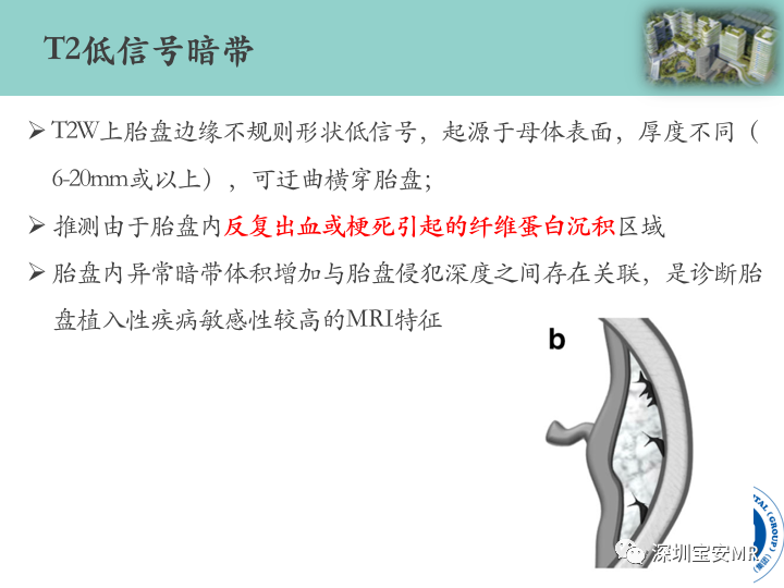 影像PPT - 【PPT】胎盘植入疾病MR评估-27