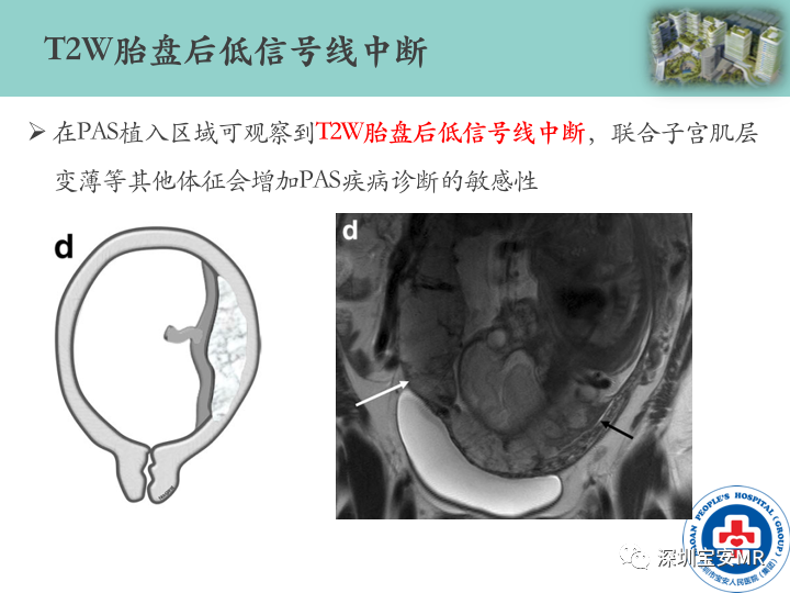 影像PPT - 【PPT】胎盘植入疾病MR评估-29