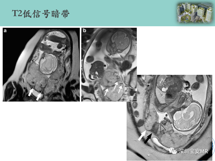 影像PPT - 【PPT】胎盘植入疾病MR评估-28