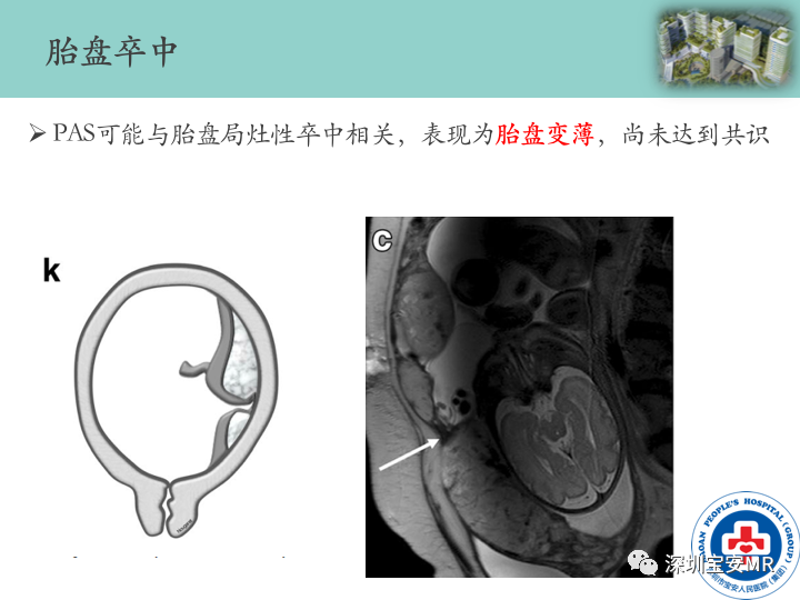 影像PPT - 【PPT】胎盘植入疾病MR评估-33