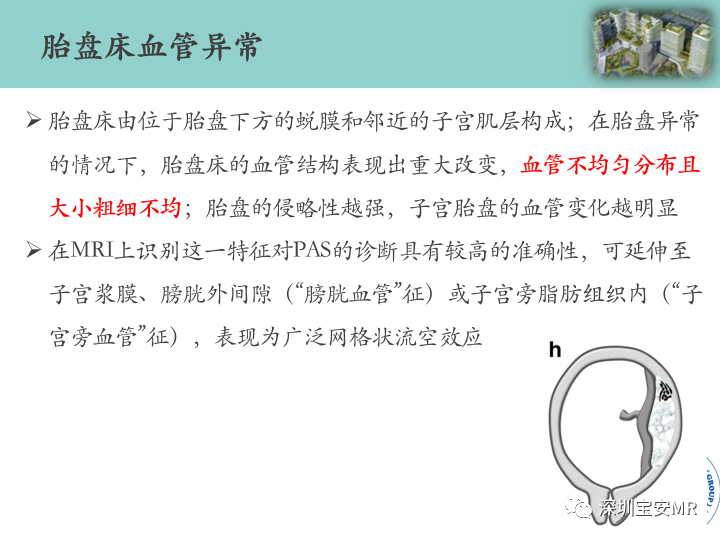 影像PPT - 【PPT】胎盘植入疾病MR评估-30