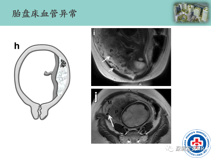 影像PPT - 【PPT】胎盘植入疾病MR评估-31