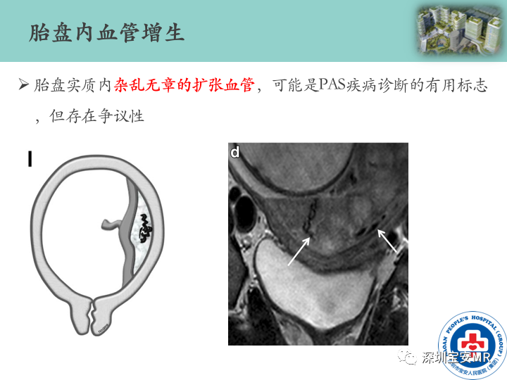 影像PPT - 【PPT】胎盘植入疾病MR评估-32