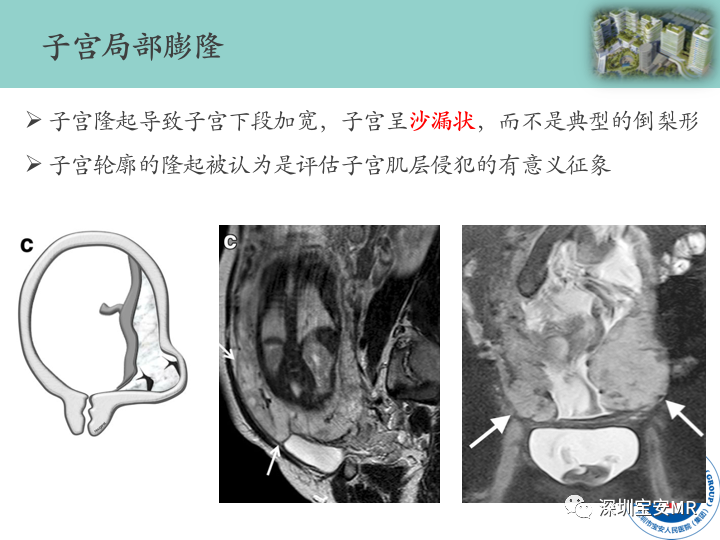 影像PPT - 【PPT】胎盘植入疾病MR评估-35