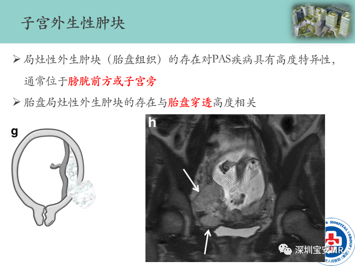 影像PPT - 【PPT】胎盘植入疾病MR评估-36