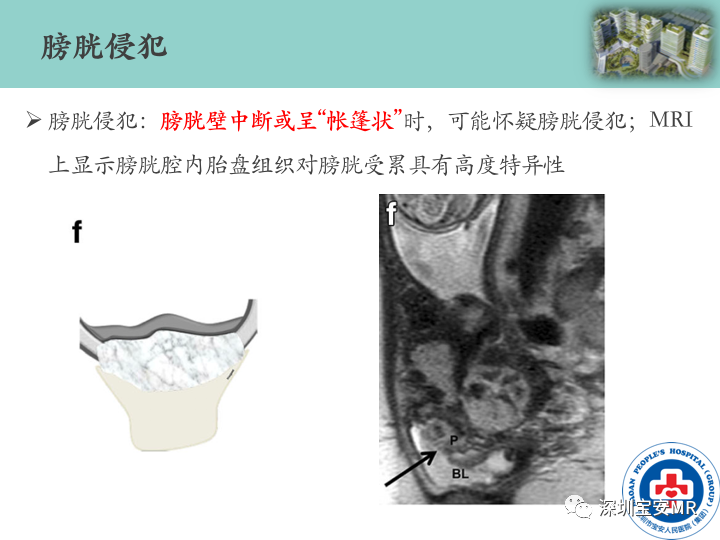 影像PPT - 【PPT】胎盘植入疾病MR评估-37