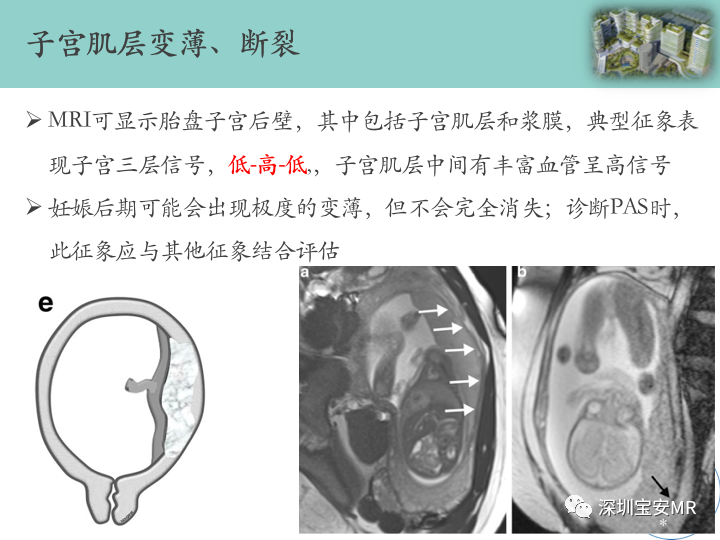 影像PPT - 【PPT】胎盘植入疾病MR评估-34