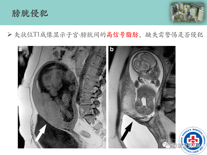 影像PPT - 【PPT】胎盘植入疾病MR评估-38