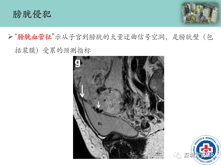 影像PPT - 【PPT】胎盘植入疾病MR评估-39