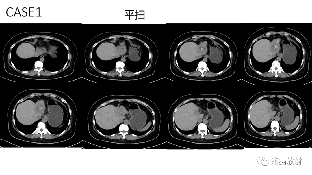影像PPT - 【病例】肝内胆管细胞癌2例CT及MR影像-3