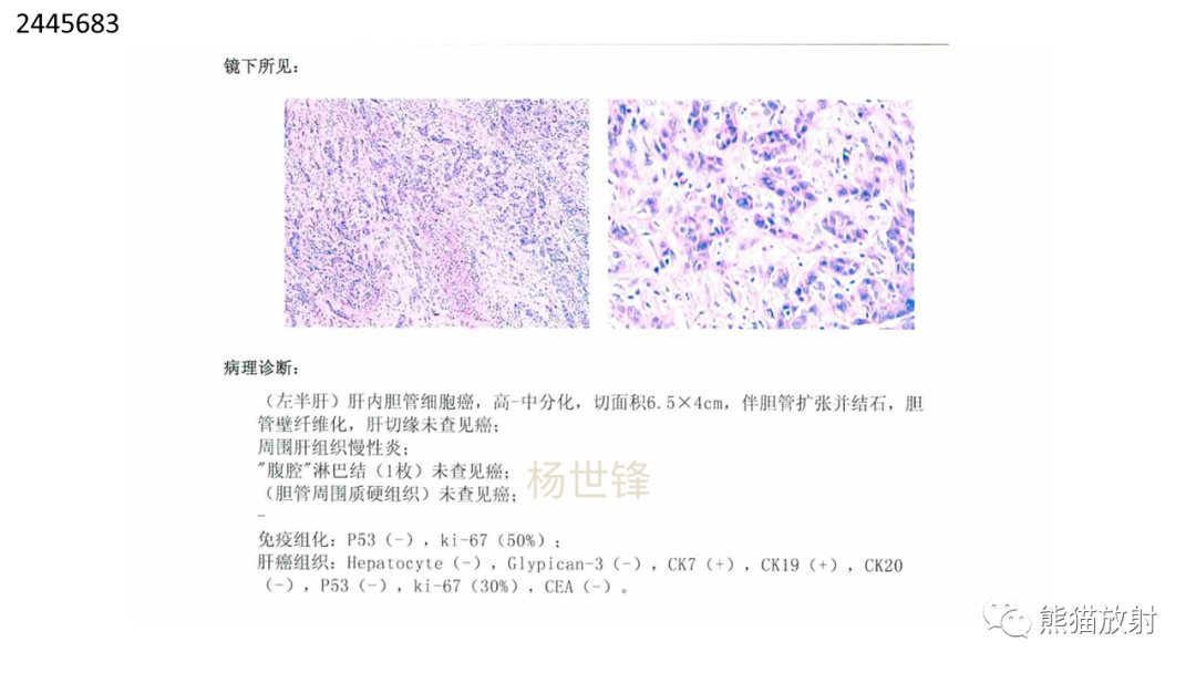 影像PPT - 【病例】肝内胆管细胞癌2例CT及MR影像-19