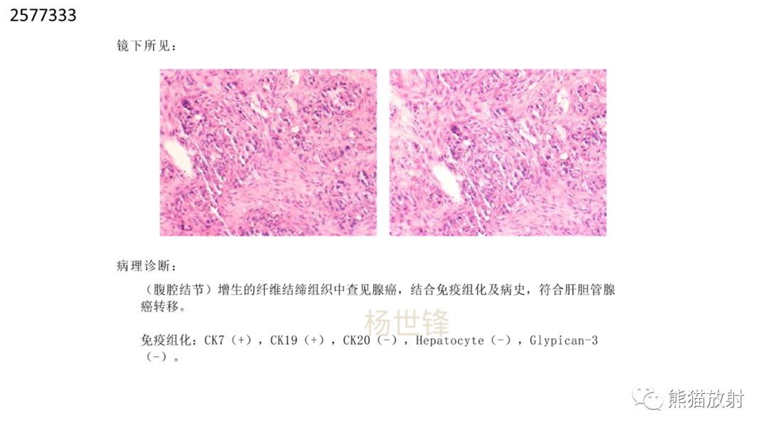 影像PPT - 【病例】肝内胆管细胞癌2例CT及MR影像-20