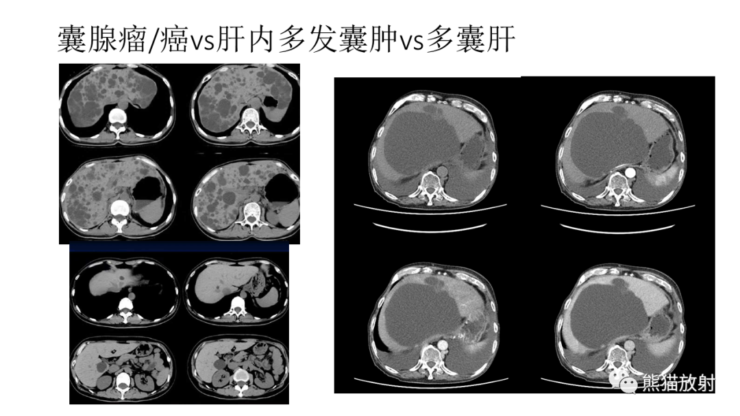 影像PPT - 【病例】肝内胆管细胞癌2例CT及MR影像-30