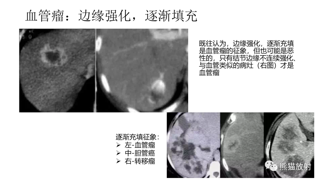 影像PPT - 【病例】肝内胆管细胞癌2例CT及MR影像-31