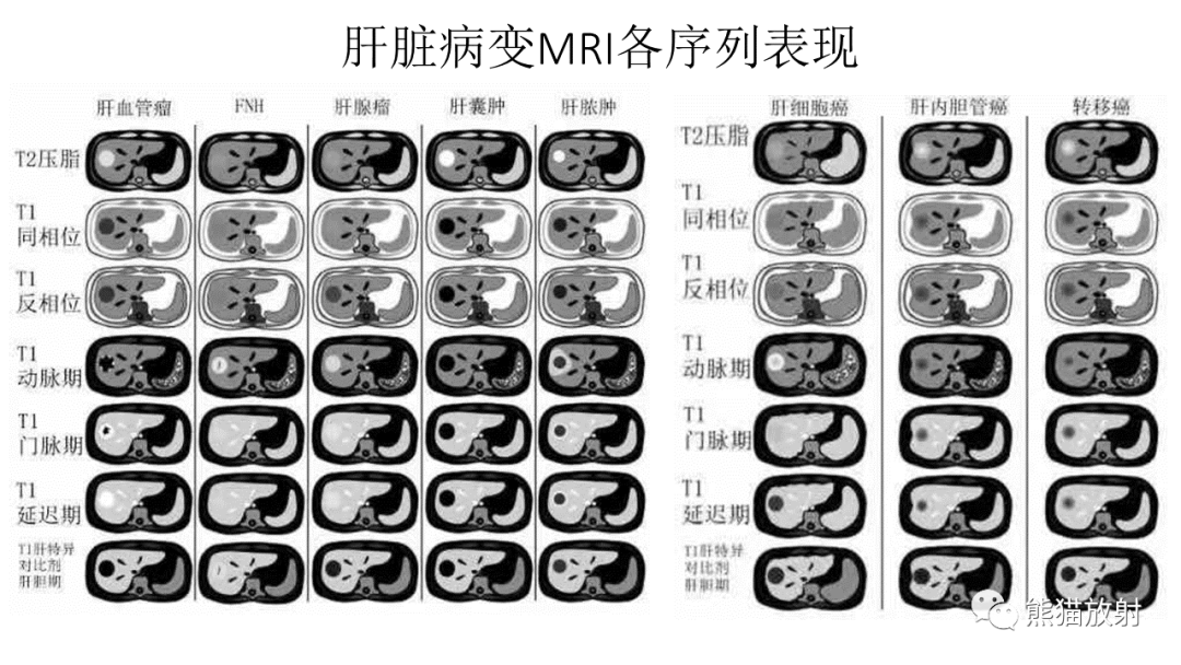 影像PPT - 【病例】肝内胆管细胞癌2例CT及MR影像-32