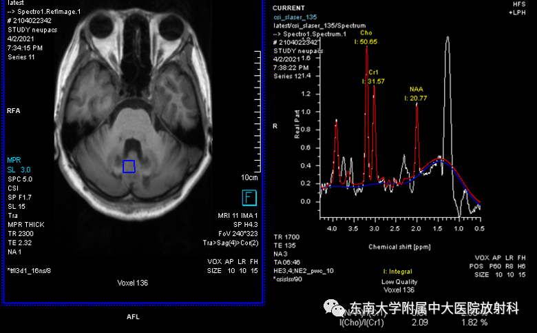 影像PPT - 【PPT】脑腱黄瘤病-2 影像PPT - 【PPT】脑腱黄瘤病-2