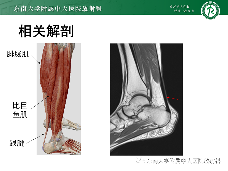 影像PPT - 【PPT】脑腱黄瘤病-6 影像PPT - 【PPT】脑腱黄瘤病-6