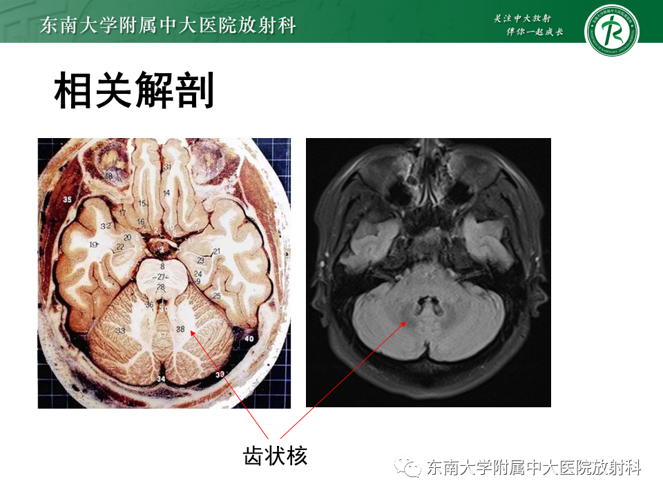 影像PPT - 【PPT】脑腱黄瘤病-7 影像PPT - 【PPT】脑腱黄瘤病-7