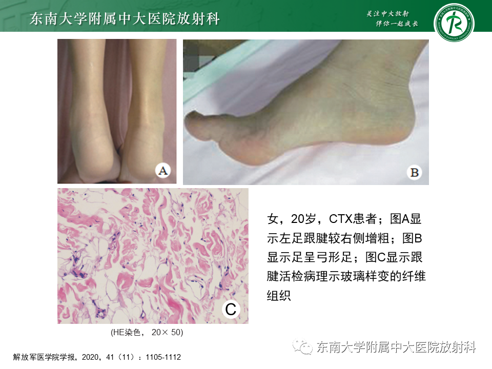 影像PPT - 【PPT】脑腱黄瘤病-12 影像PPT - 【PPT】脑腱黄瘤病-12