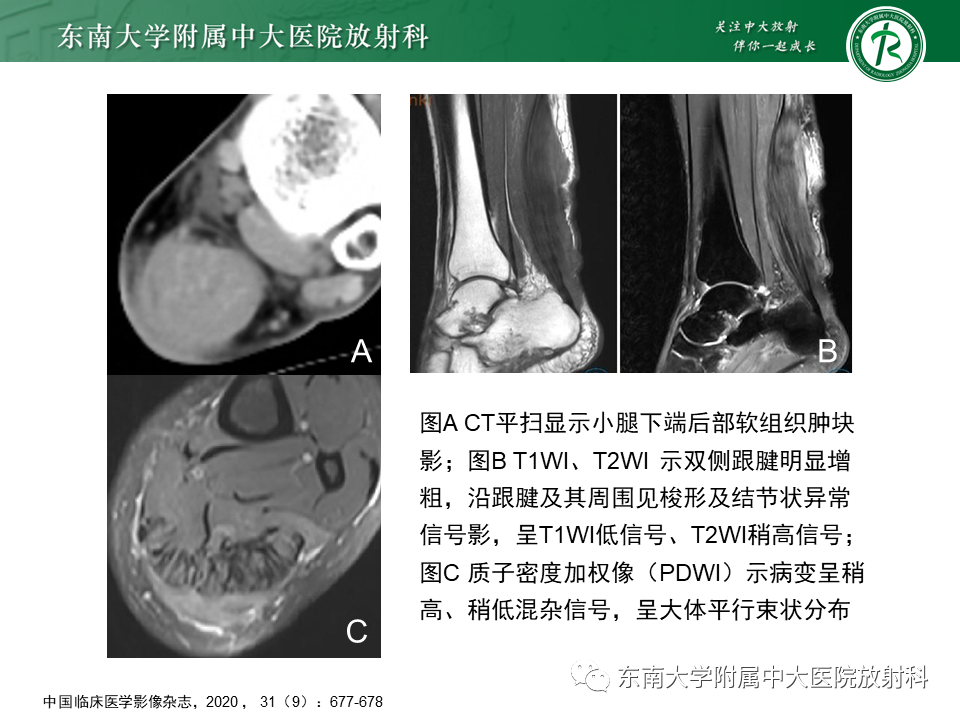 影像PPT - 【PPT】脑腱黄瘤病-17 影像PPT - 【PPT】脑腱黄瘤病-17