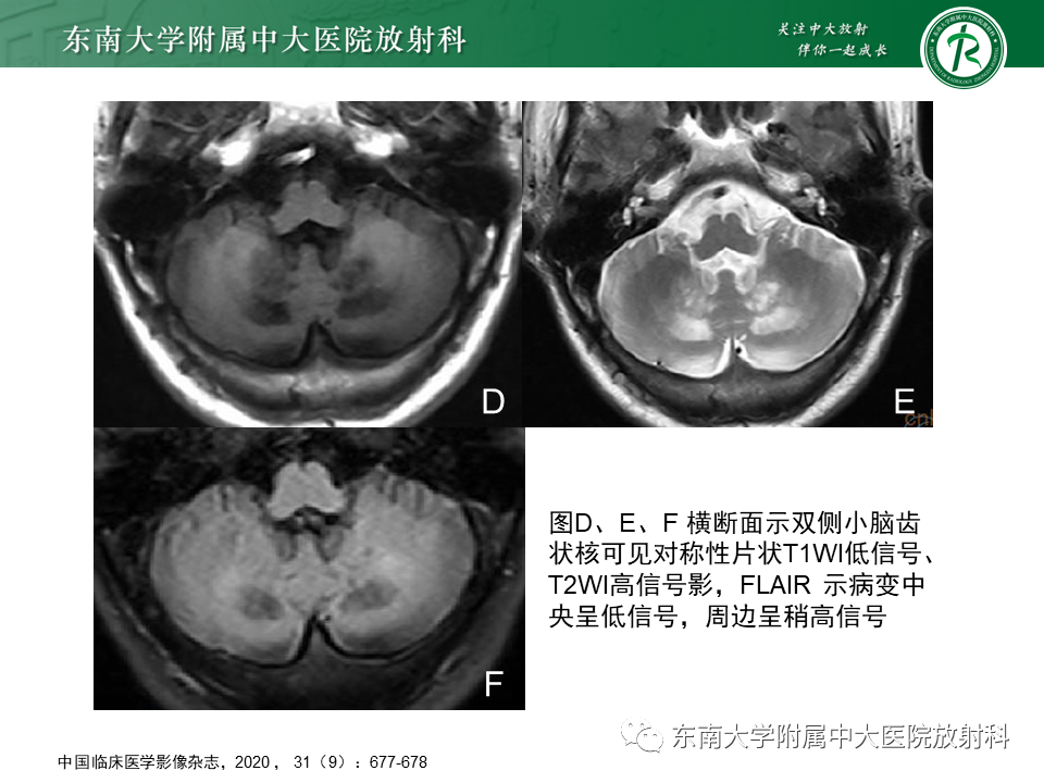 影像PPT - 【PPT】脑腱黄瘤病-18 影像PPT - 【PPT】脑腱黄瘤病-18