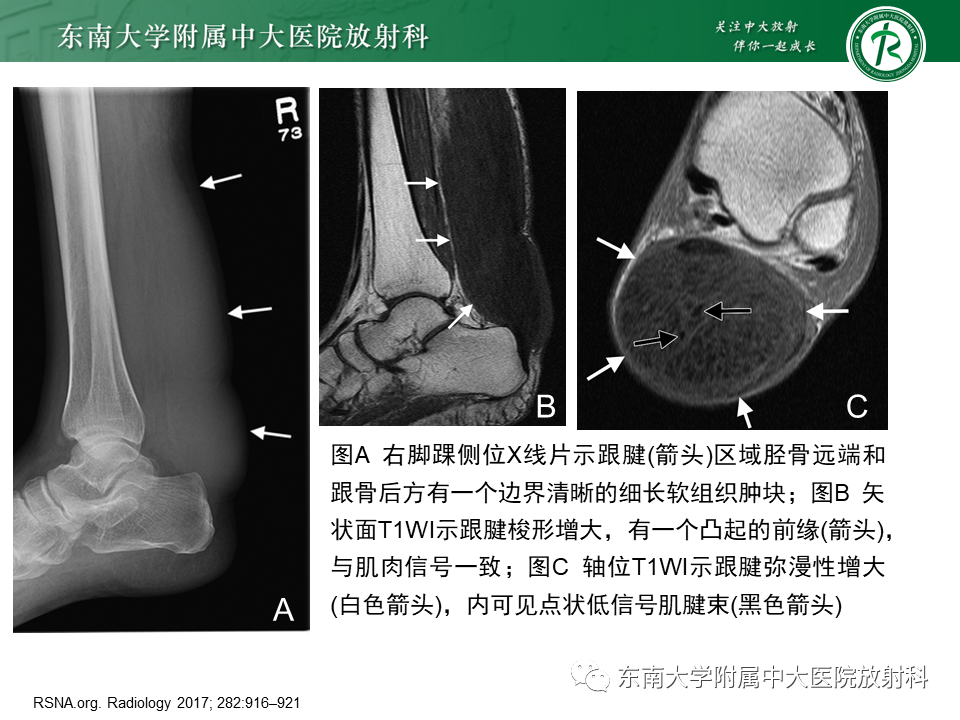 影像PPT - 【PPT】脑腱黄瘤病-20 影像PPT - 【PPT】脑腱黄瘤病-20