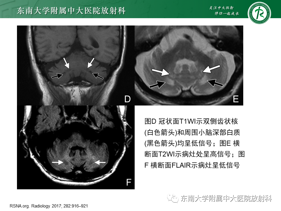 影像PPT - 【PPT】脑腱黄瘤病-21 影像PPT - 【PPT】脑腱黄瘤病-21