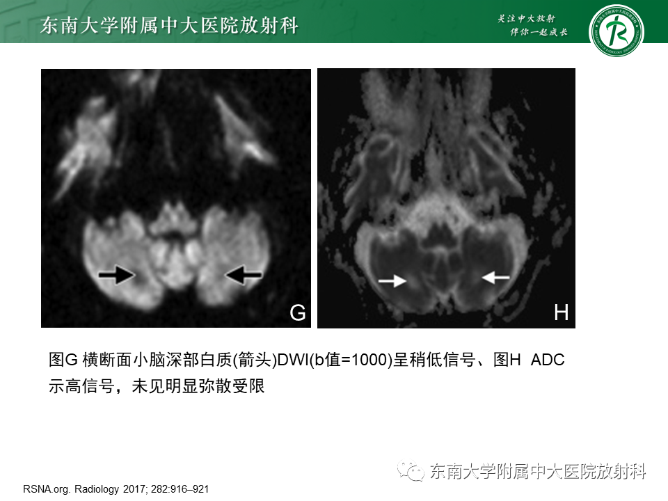 影像PPT - 【PPT】脑腱黄瘤病-22 影像PPT - 【PPT】脑腱黄瘤病-22