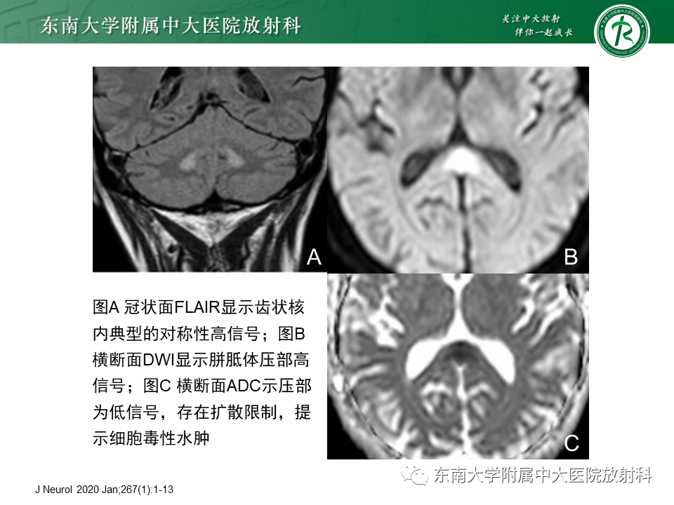 影像PPT - 【PPT】脑腱黄瘤病-24 影像PPT - 【PPT】脑腱黄瘤病-24