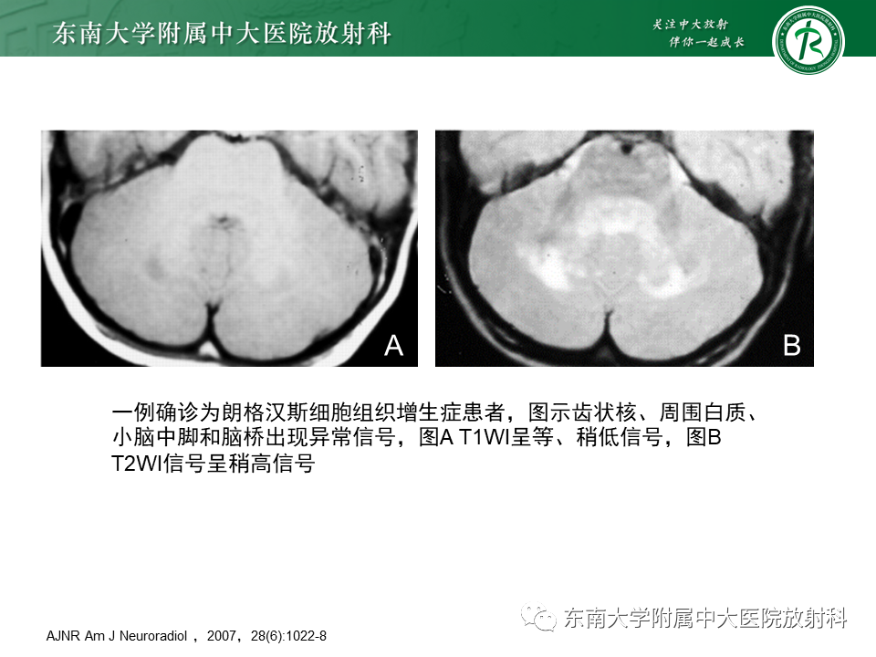 影像PPT - 【PPT】脑腱黄瘤病-26 影像PPT - 【PPT】脑腱黄瘤病-26