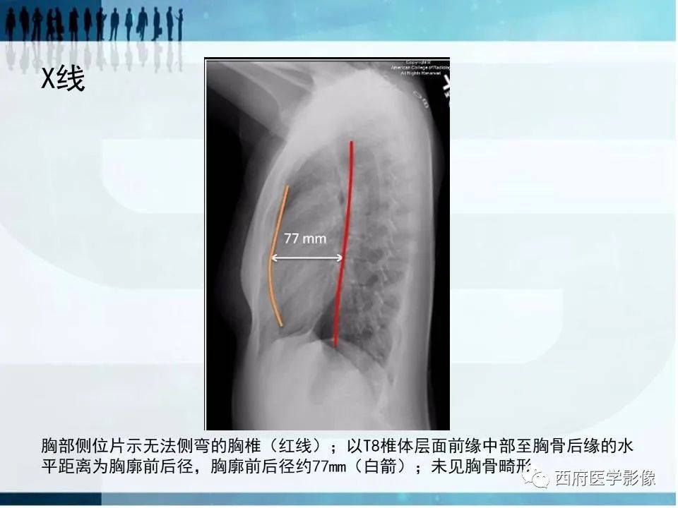 影像PPT - 【PPT】直背综合征影像诊断要点-5
