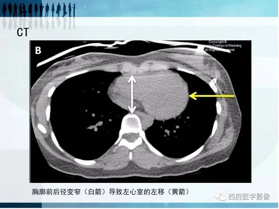 影像PPT - 【PPT】直背综合征影像诊断要点-6