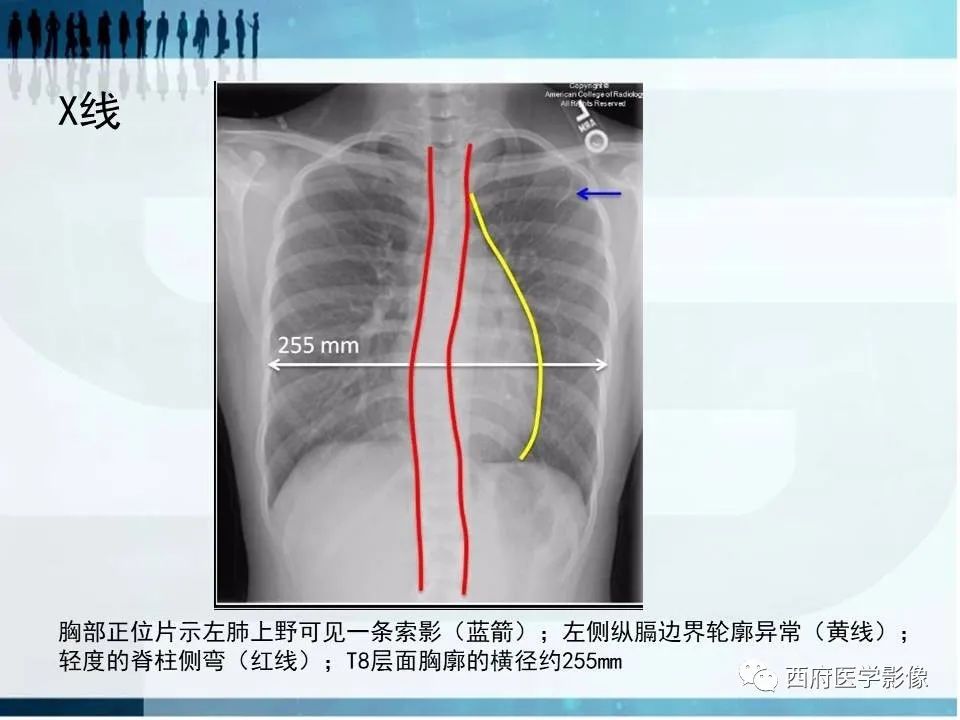 影像PPT - 【PPT】直背综合征影像诊断要点-4