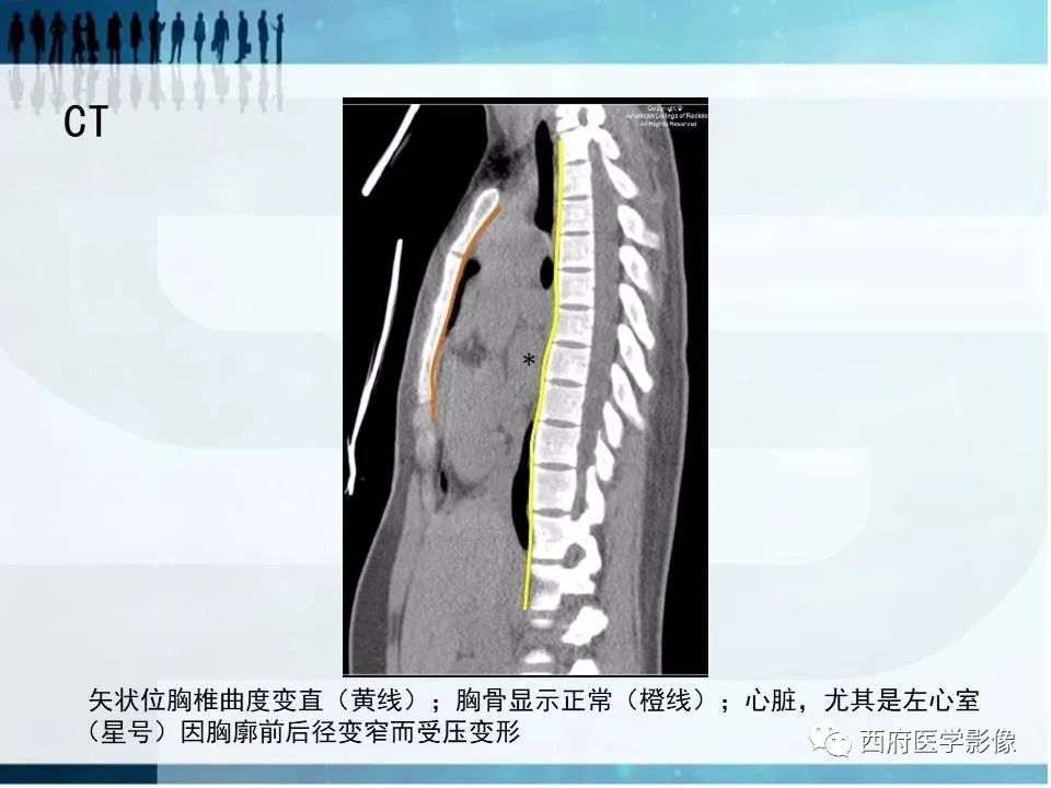 影像PPT - 【PPT】直背综合征影像诊断要点-8