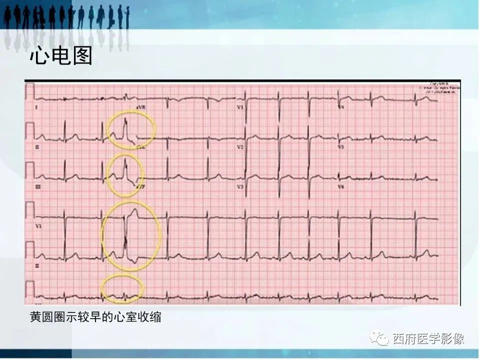 影像PPT - 【PPT】直背综合征影像诊断要点-9