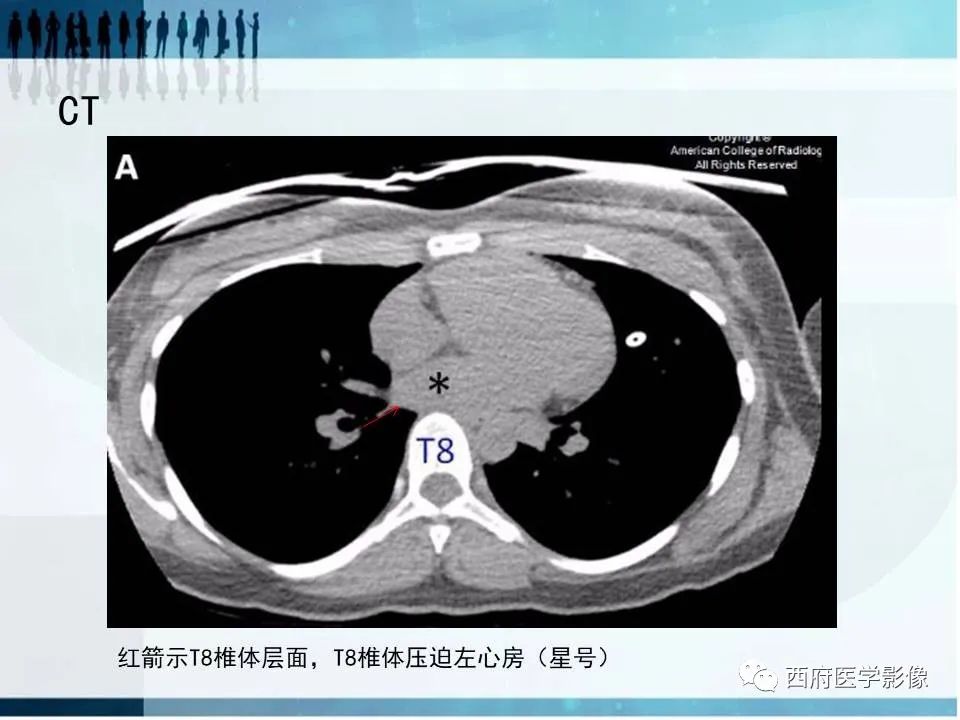 影像PPT - 【PPT】直背综合征影像诊断要点-7