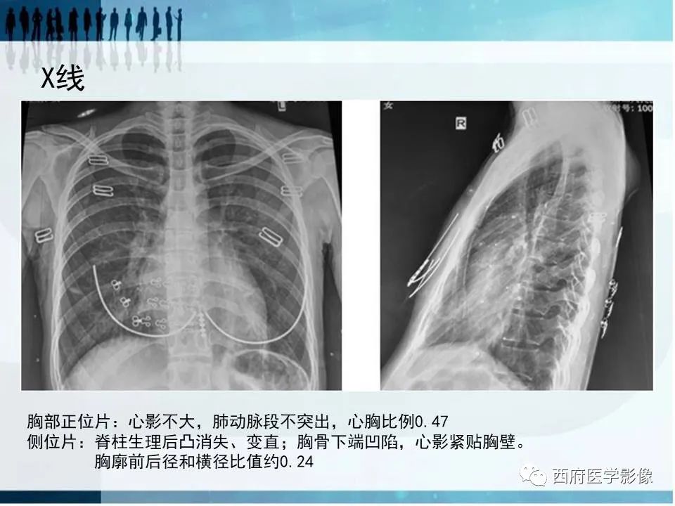 影像PPT - 【PPT】直背综合征影像诊断要点-12