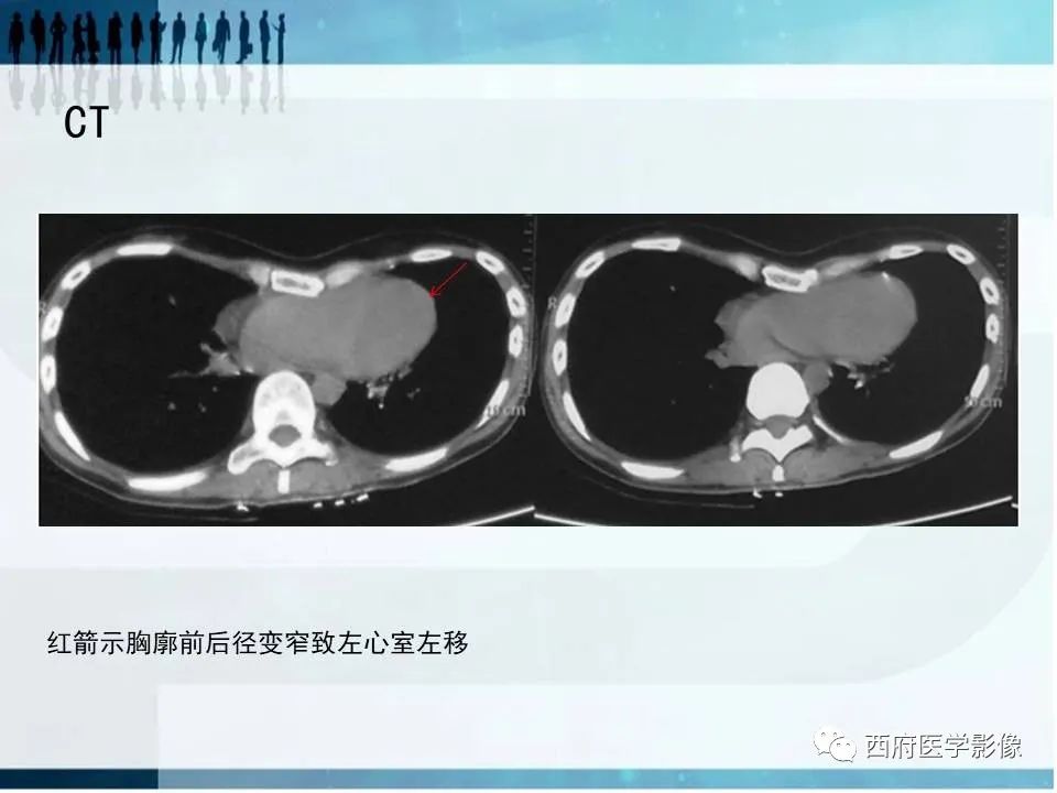 影像PPT - 【PPT】直背综合征影像诊断要点-13