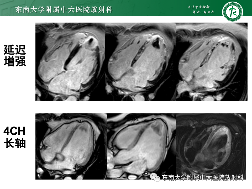 影像PPT - 【PPT】CMR在心肌梗死中的运用-8 影像PPT - 【PPT】CMR在心肌梗死中的运用-8
