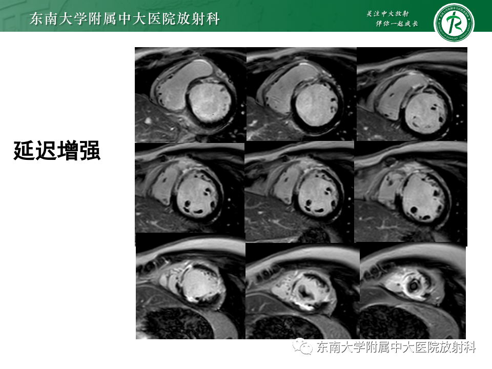 影像PPT - 【PPT】CMR在心肌梗死中的运用-9 影像PPT - 【PPT】CMR在心肌梗死中的运用-9