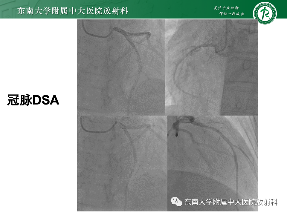 影像PPT - 【PPT】CMR在心肌梗死中的运用-13 影像PPT - 【PPT】CMR在心肌梗死中的运用-13