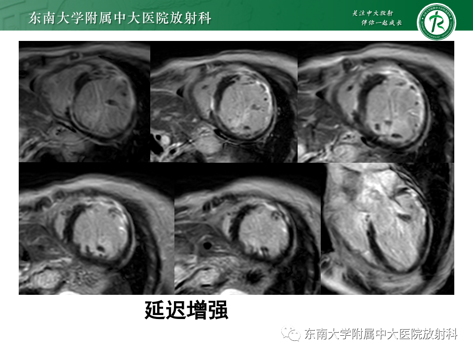 影像PPT - 【PPT】CMR在心肌梗死中的运用-14 影像PPT - 【PPT】CMR在心肌梗死中的运用-14