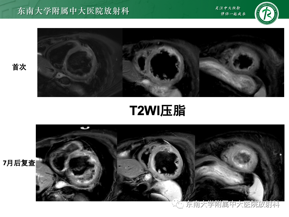 影像PPT - 【PPT】CMR在心肌梗死中的运用-15 影像PPT - 【PPT】CMR在心肌梗死中的运用-15